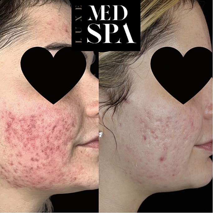 Before and after acne treatment results.